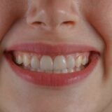 Dents