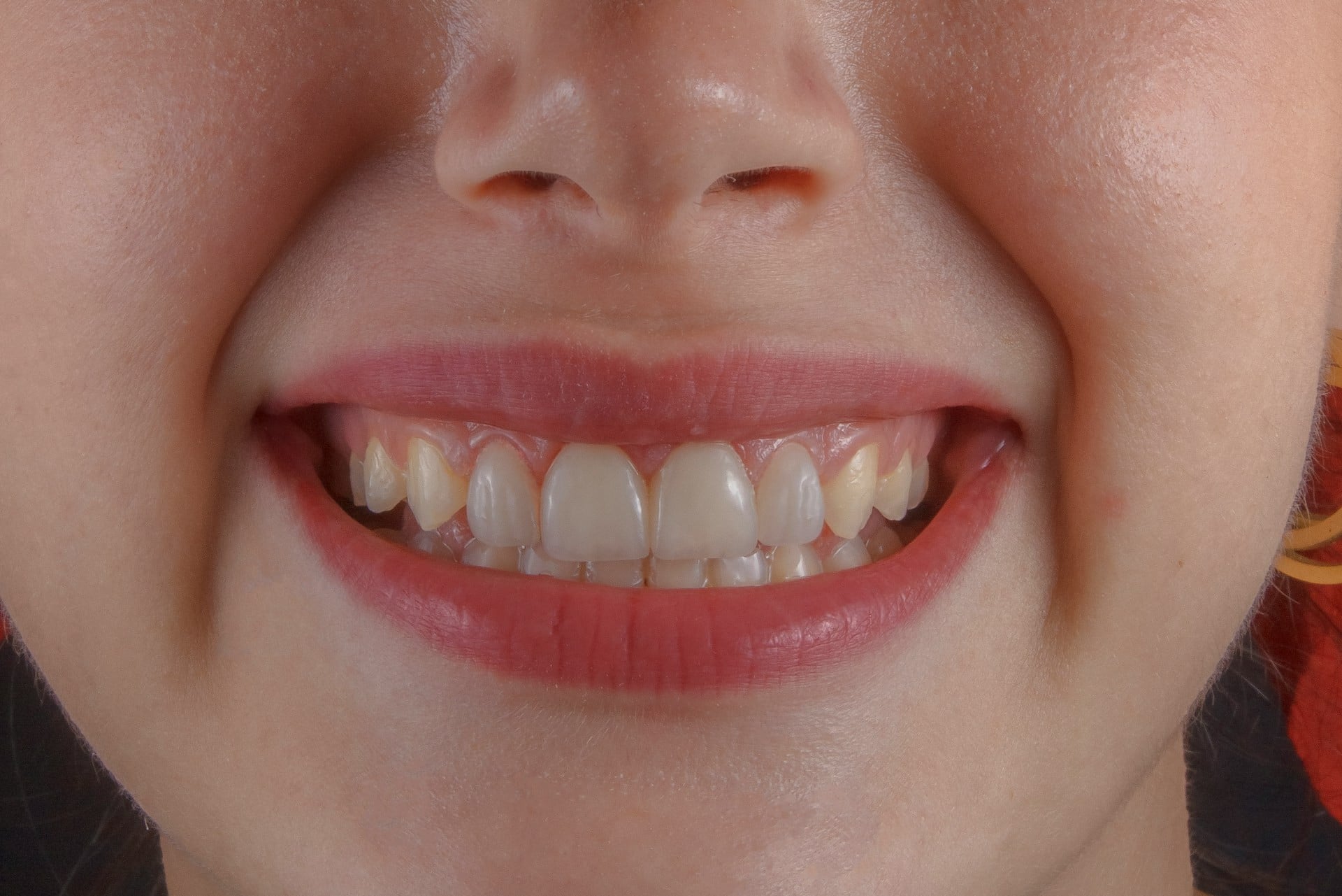 Dents