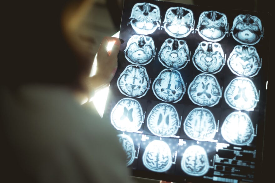 Des scientifiques japonais font une découverte immense sur la maladie d’Alzheimer