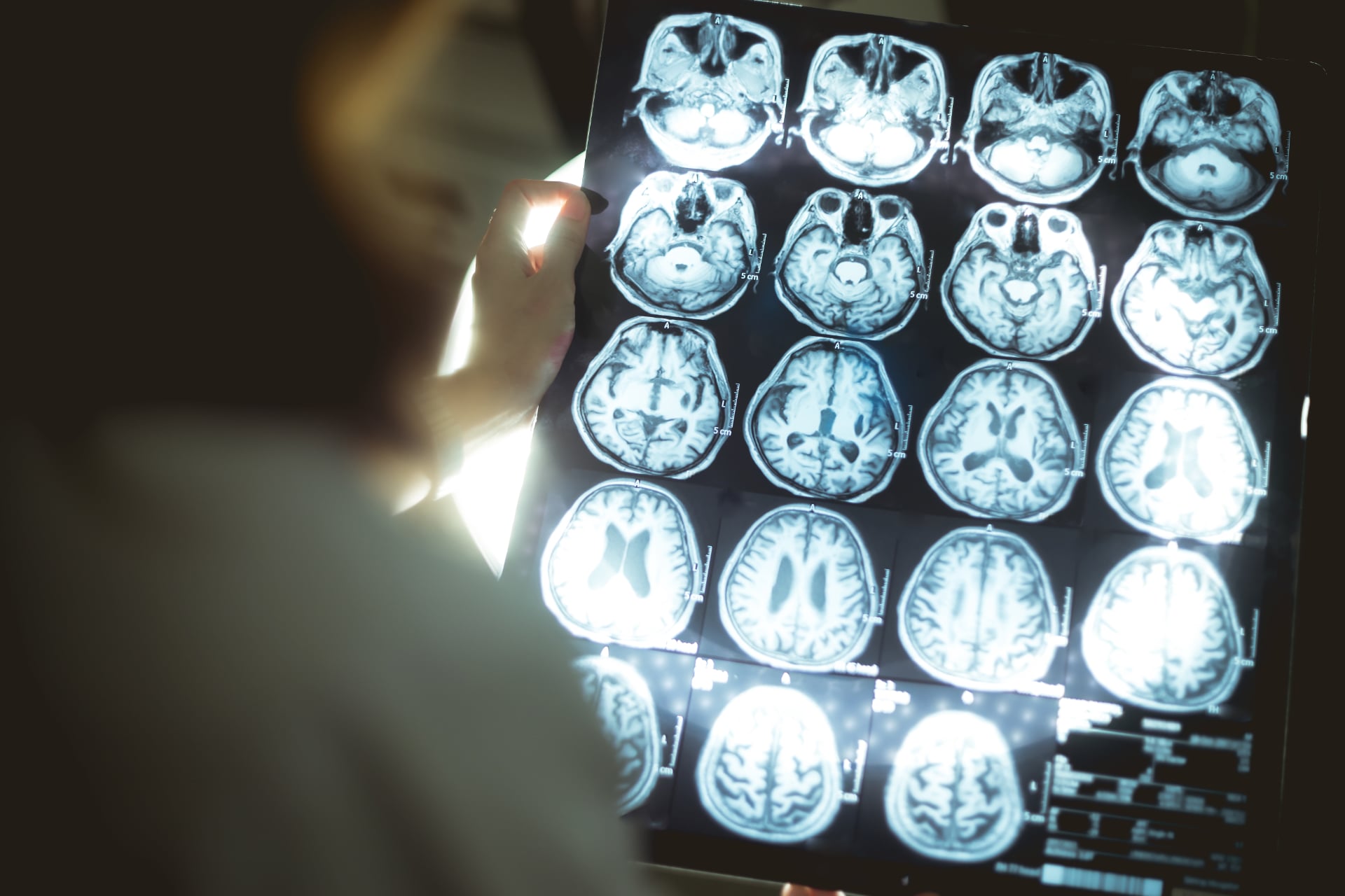 alzheimer decouverte scientifique japon