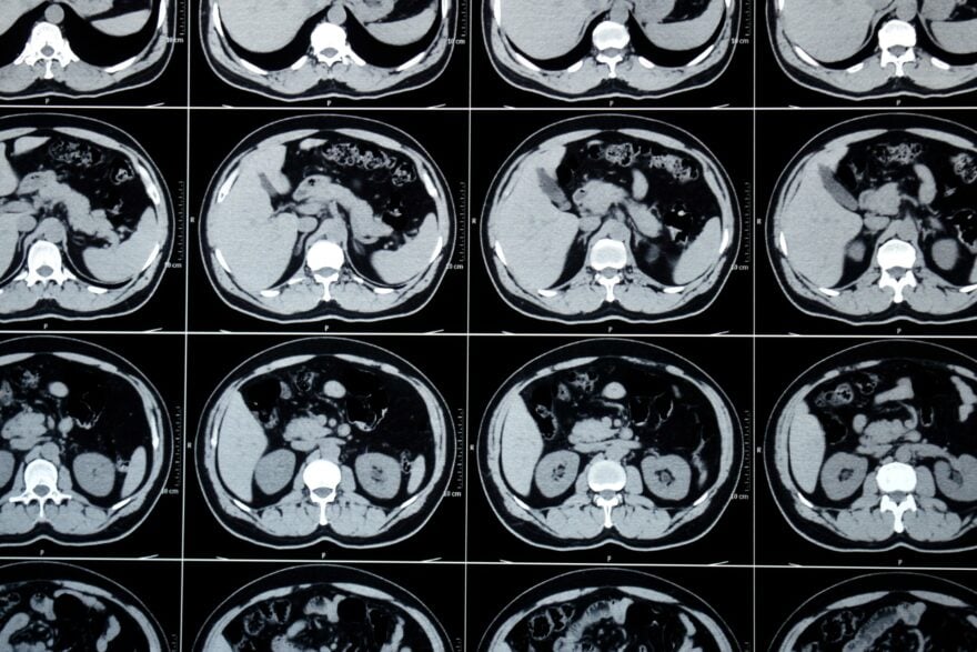 Alibaba dévoile deux IA révolutionnaires capables de détecter des cancers sur de simples scanners